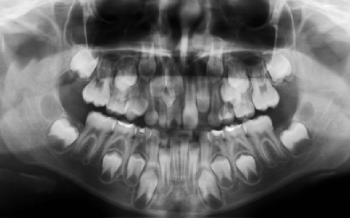 Полиодонтия (сверхкомплектные зубы) у человека – симптомы и лечение